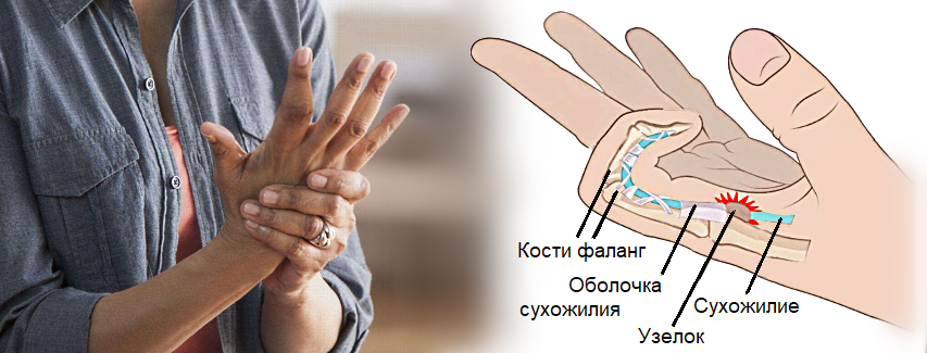 Причины воспалительного процесса в суставах пальцев рук
